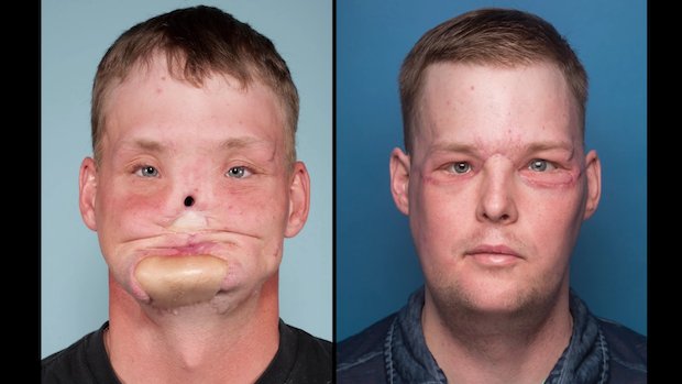 Facial Reconstruction Surgery