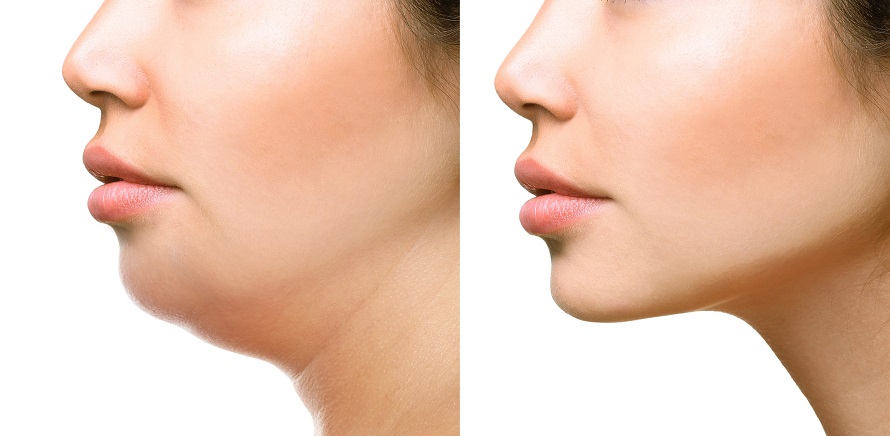 How Long Does Cheek Liposuction Last