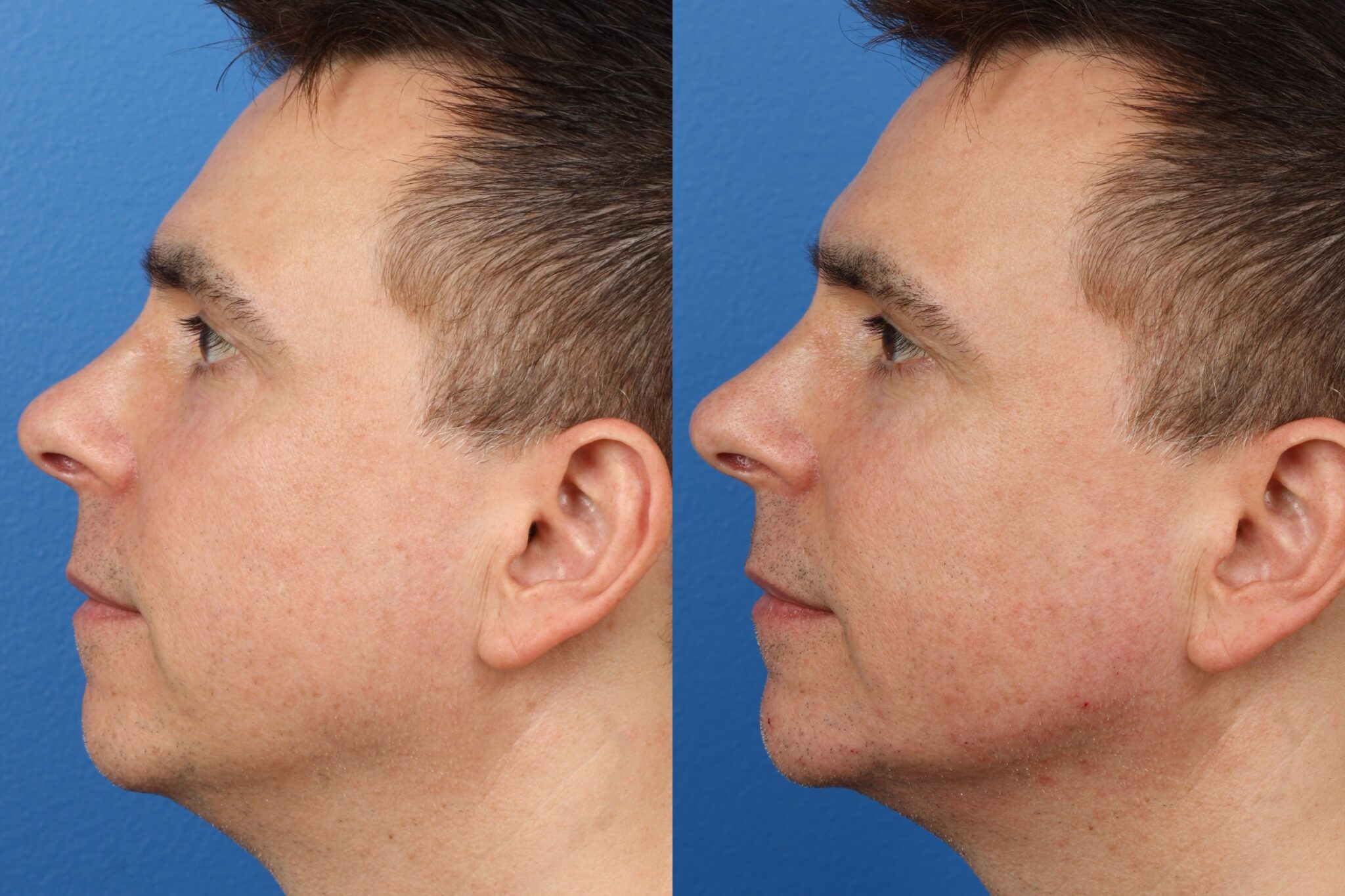 Jaw Reduction Surgery