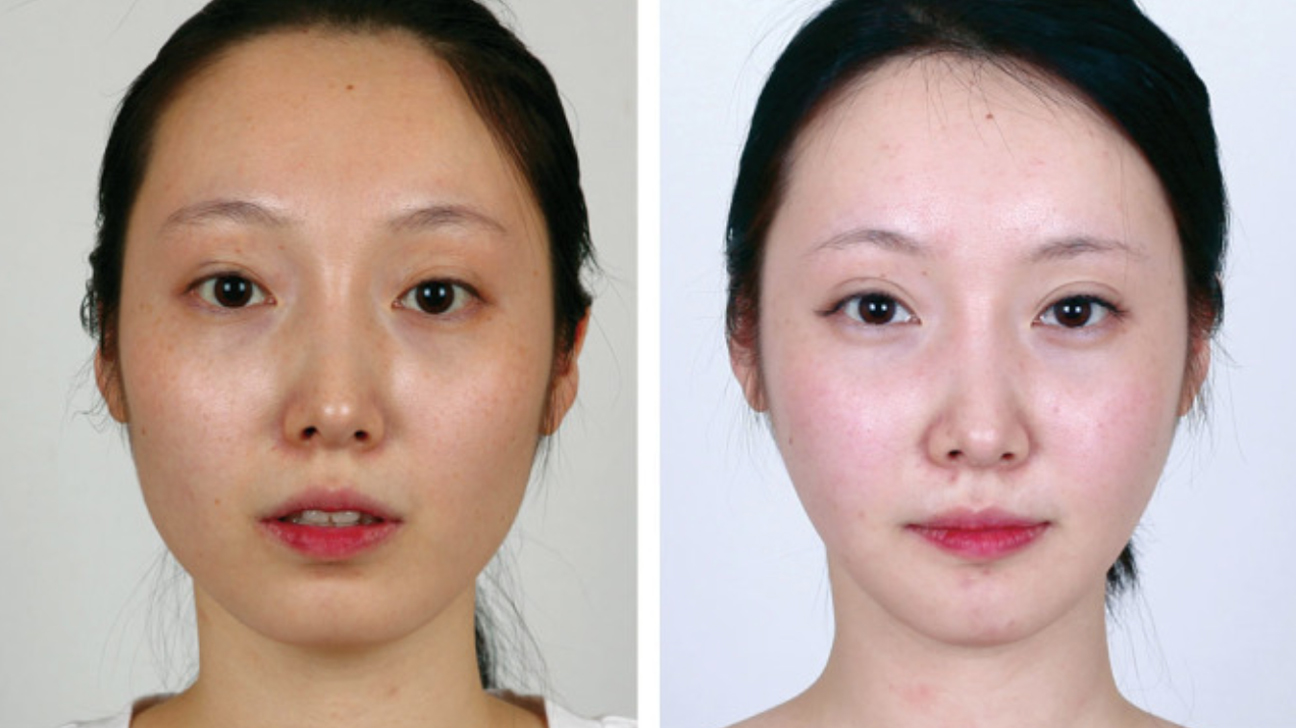 Jaw Reduction Surgery
