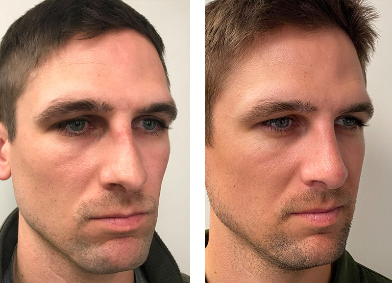 Male Rhinoplasty