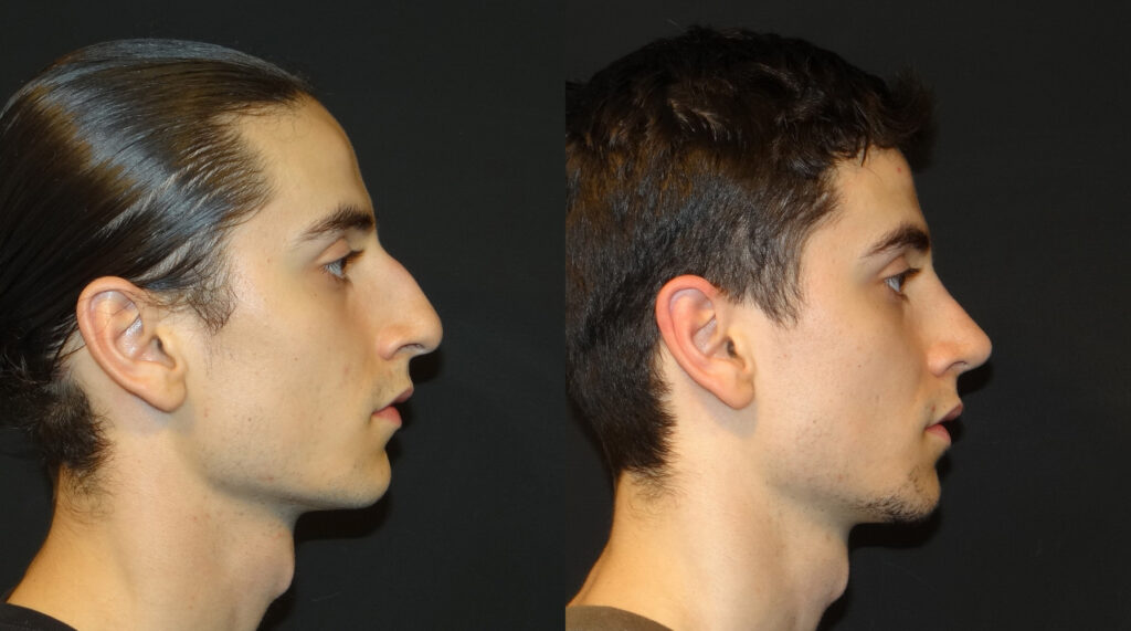 Should Men Rhinoplasty
