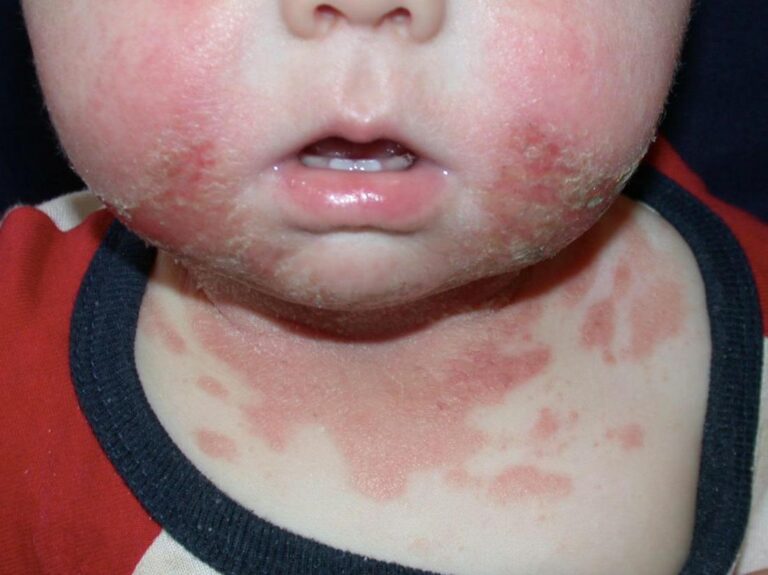 Drool Rash vs Eczema