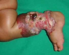 What Happens When a Hemangioma Ulcerated