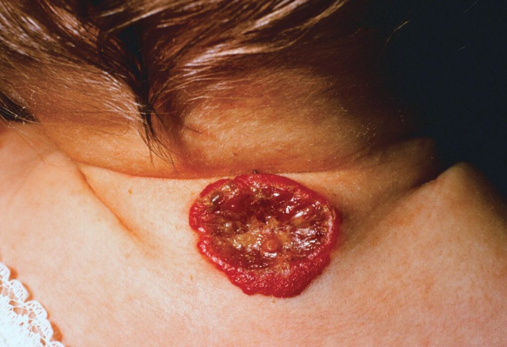 What Is An Ulcerated Hemangioma