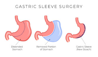 Gastric Sleeve Same Day Surgery