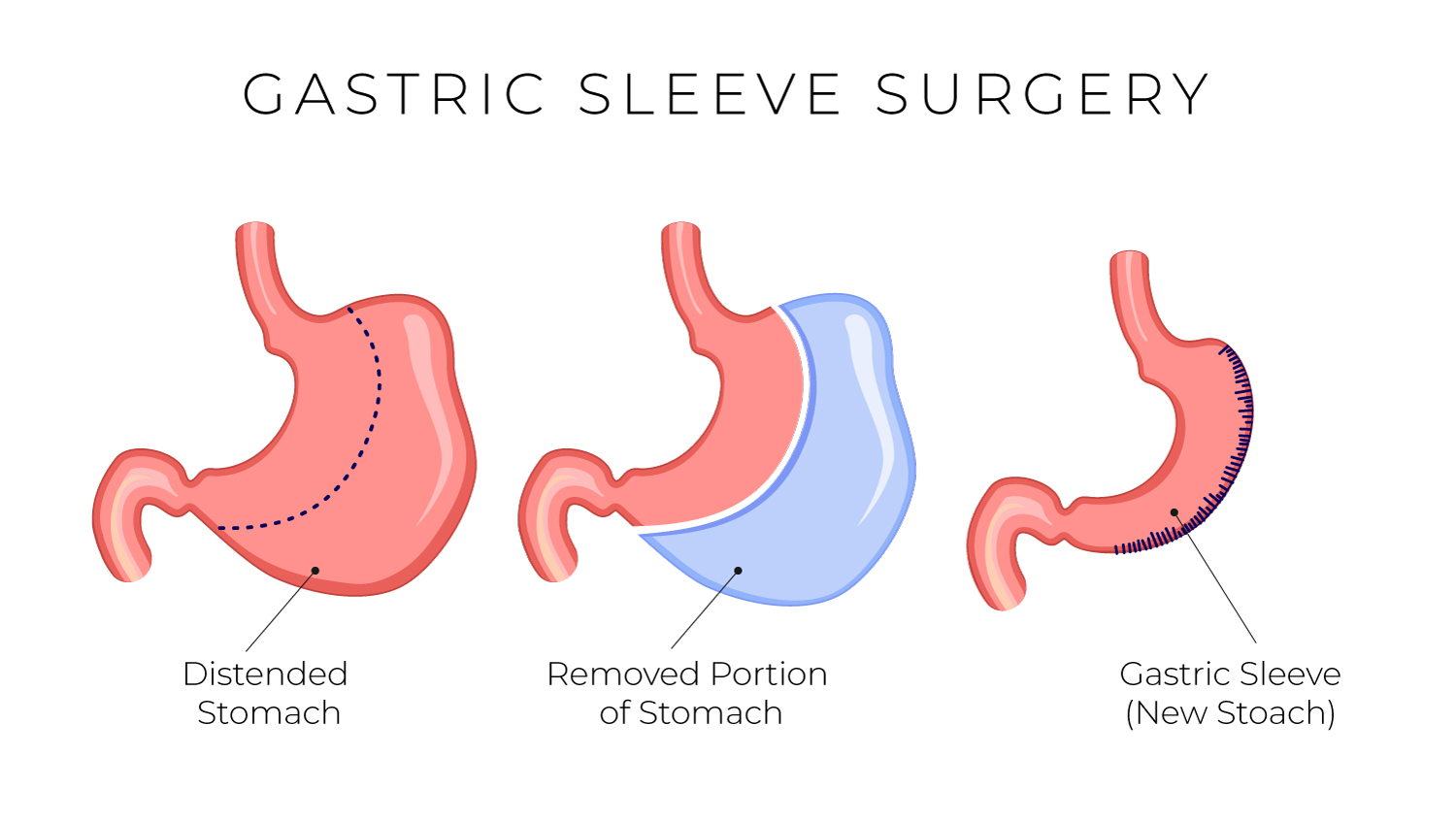 Gastric Sleeve Same Day Surgery