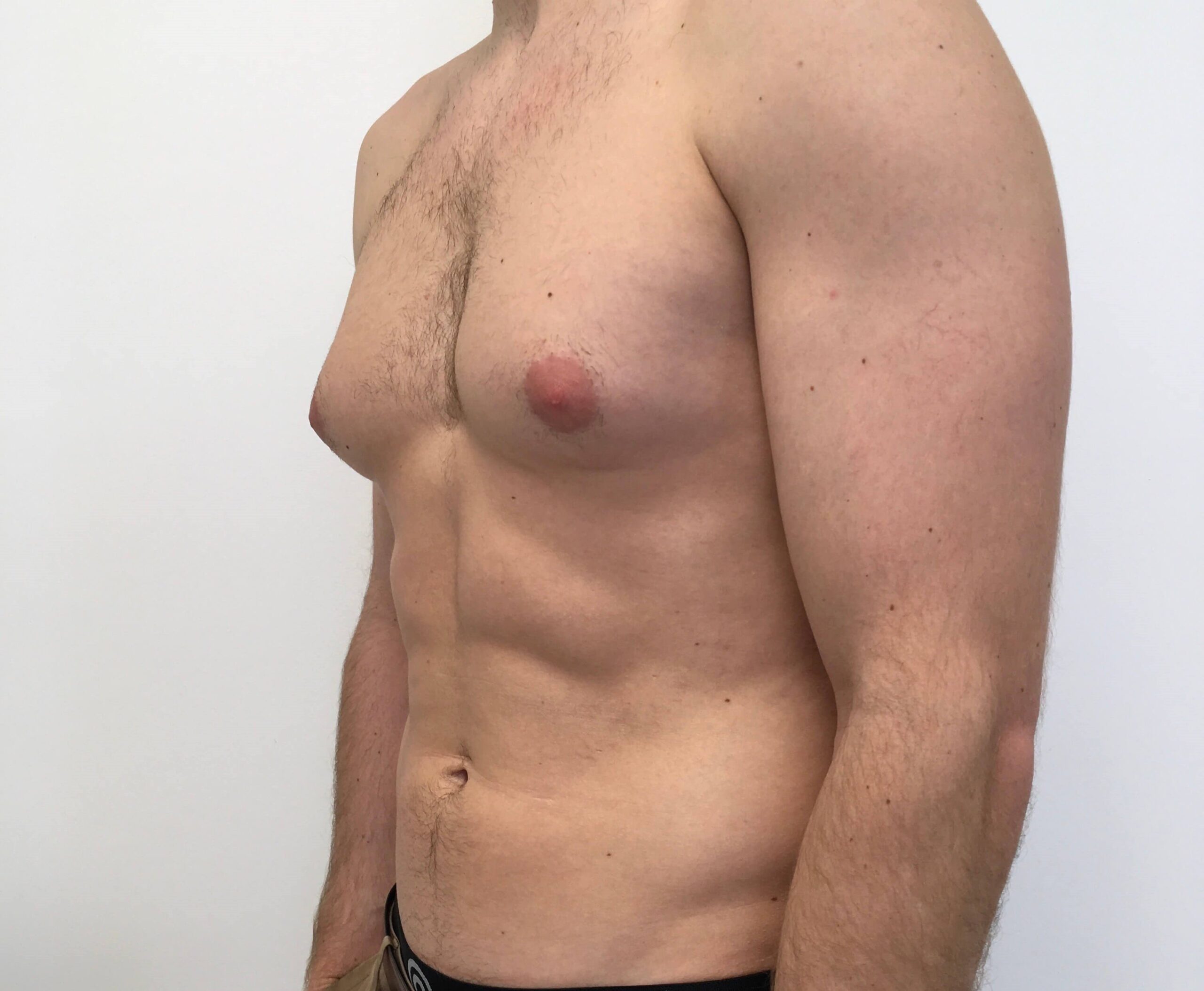 Gyno Boobs