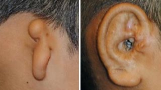 How Long Is Ear Reconstruction Surgery