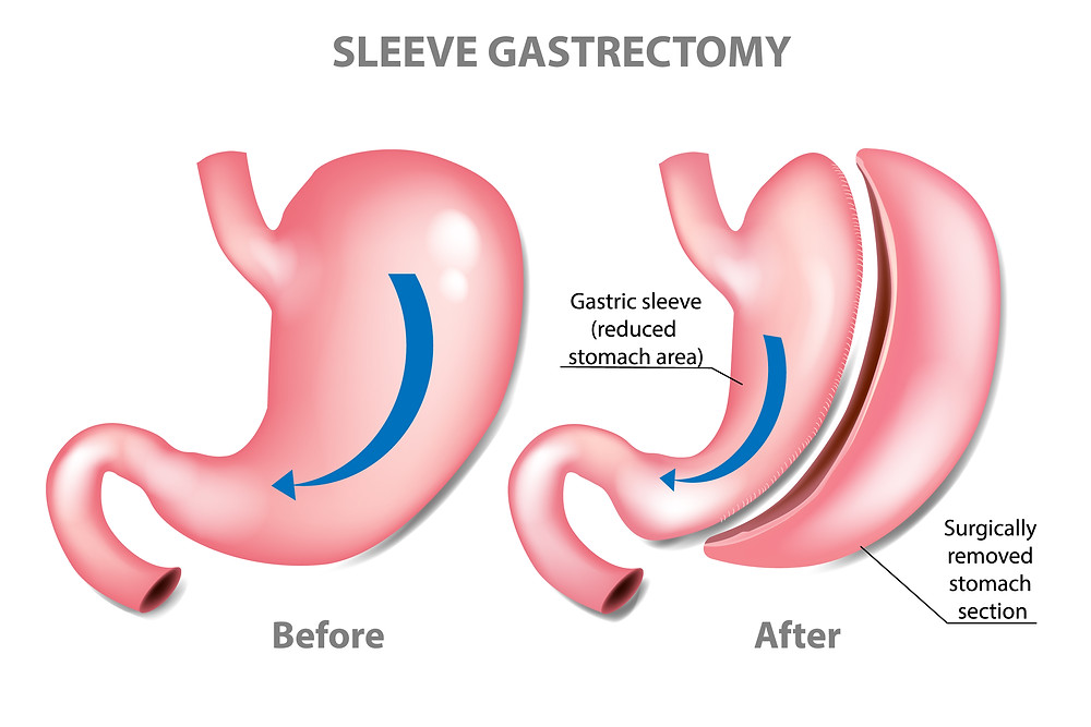 Is Gastric Sleeve A Day Surgery