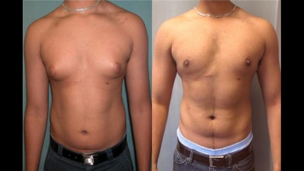 Can Gynecomastia Be Removed Without Surgery