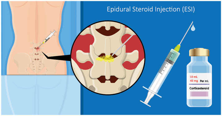 How Painful Is A Lumbar Epidural Steroid Injection