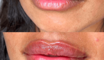 1ml Lip Filler Before and After Thin Lips