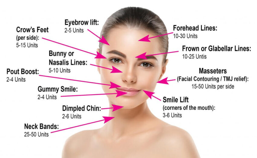 Botox Areas