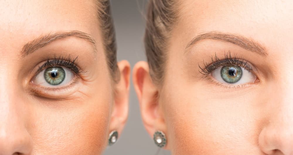 Can Botox be used under eyes