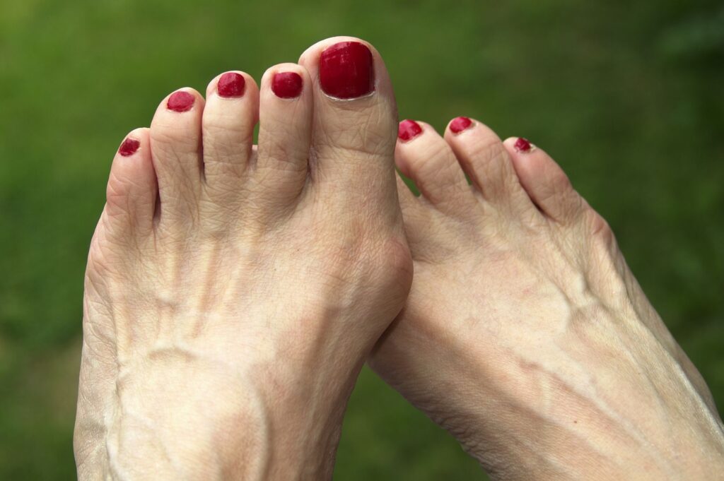 Can I walk 6 weeks after bunion surgery