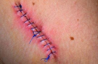Can a wound heal if it is infected