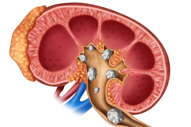Can kidney stones cause blood in urine