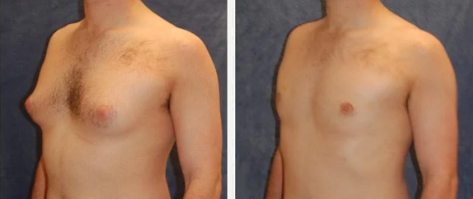 Does Gynecomastia Come Back After Liposuction