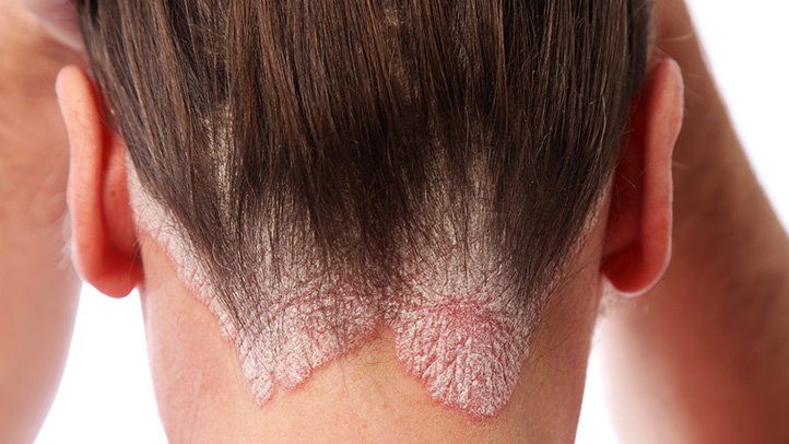 How Long Does Scalp Psoriasis Last