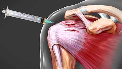 How long should I rest my shoulder after steroid injection?
