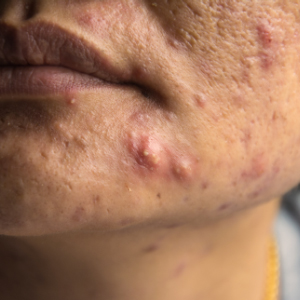 Is Nodular Acne The Same As Cystic Acne