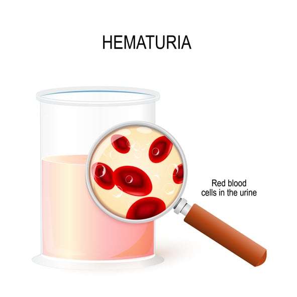 Is hematuria an emergency