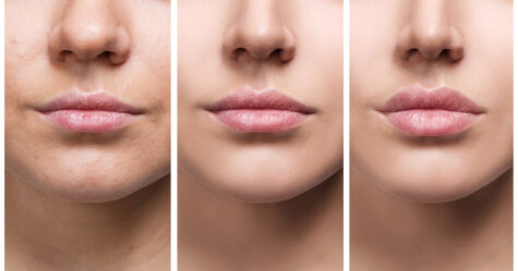 Lip Filler Swelling Timeline