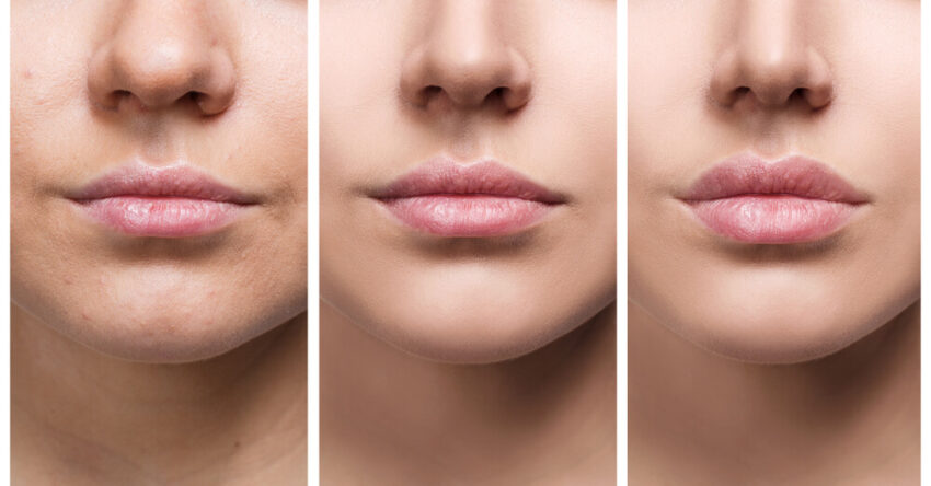 Lip Filler Swelling Timeline