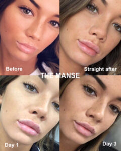 Lip Filler Swelling Timeline