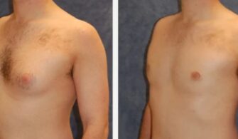Liposuction For Male Gynecomastia