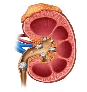 Should I worry about kidney stone?