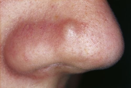 What Does Nodular Acne Look Like