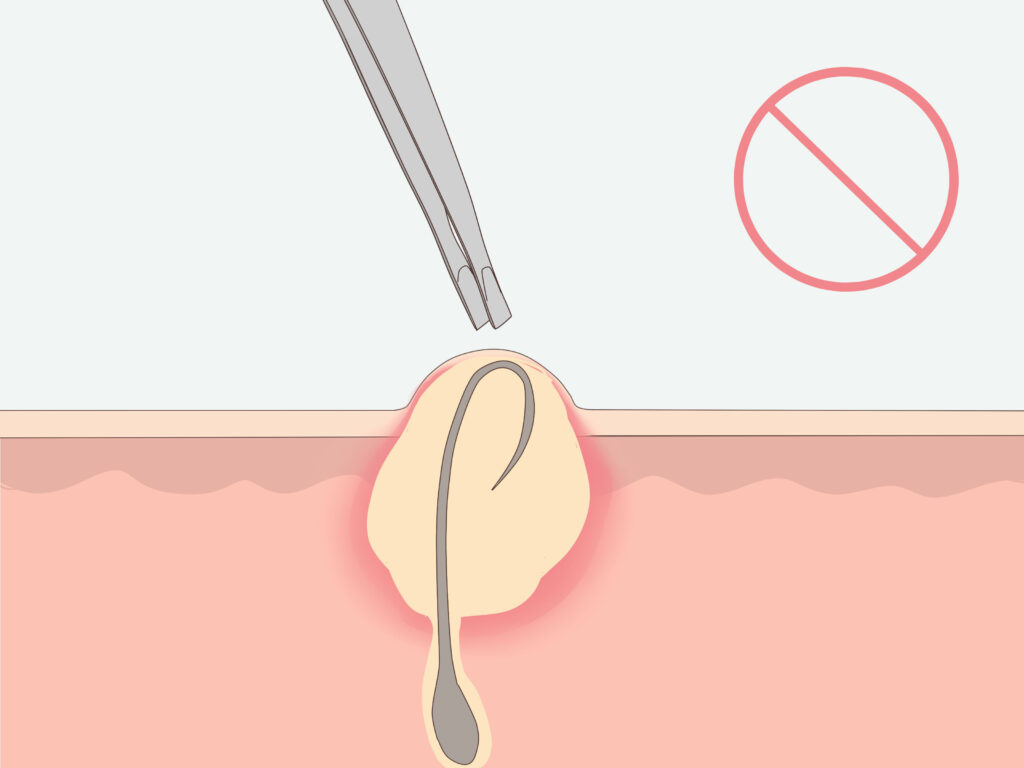 What causes ingrown hair?