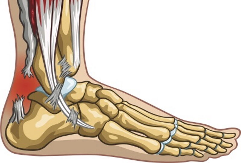 What happens when a tendon ruptures?
