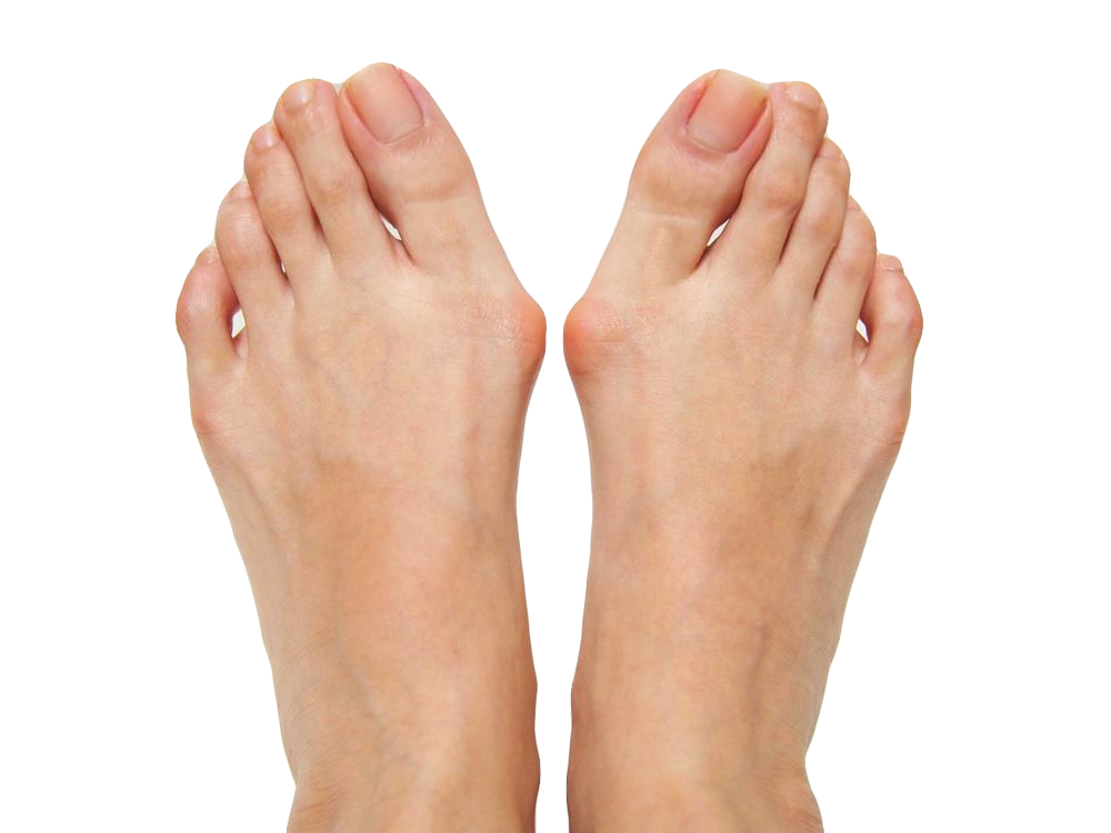 What is the latest treatment for bunions