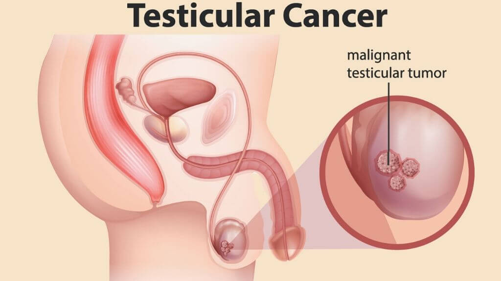 What is the main cause of testicle pain