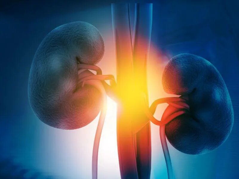What is the number one cause of kidney stones