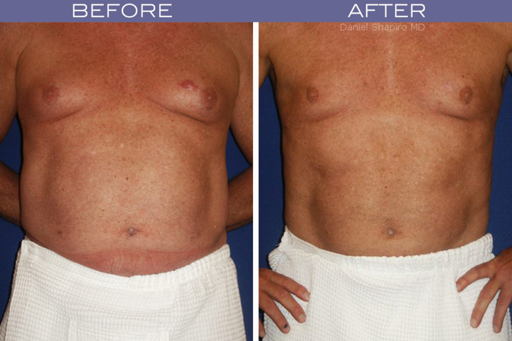 Which Surgery is Best For Gynecomastia?