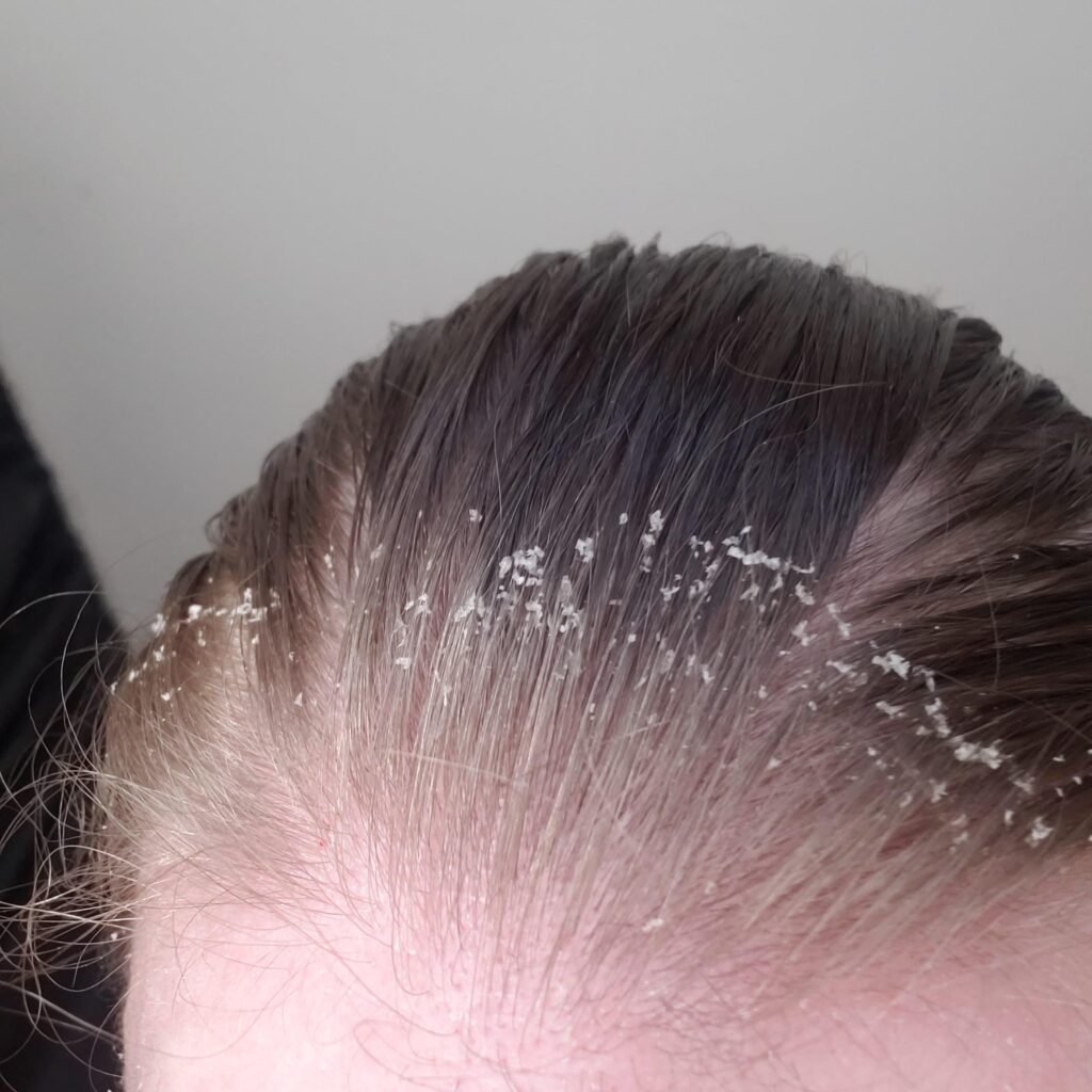 Why do I have dandruff even after washing my hair