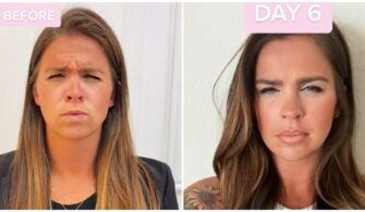 Botox Day 7 vs Day 14