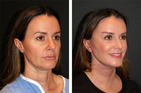 Facelift Before and After