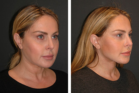 Facelift before and after 40-year-old