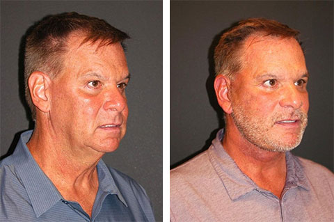 Facelift before and after male