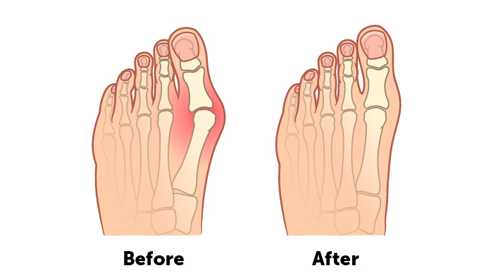 How long does bunion surgery take
