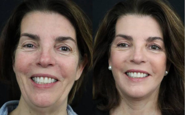 How long does it take to look normal after a facelift