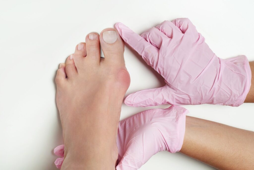 How long should you stay off your feet after bunion surgery
