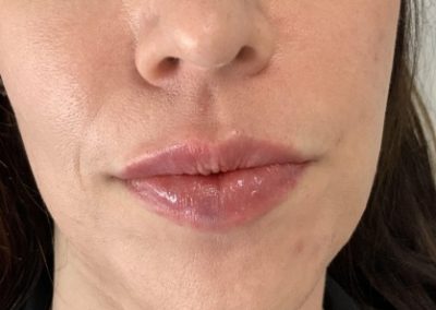 Vascular occlusion Lip filler treatment