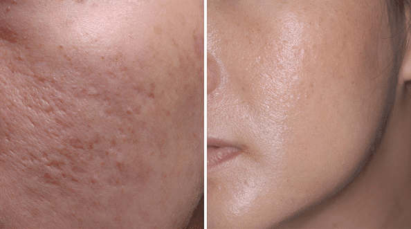 Acne Scars Before and After
