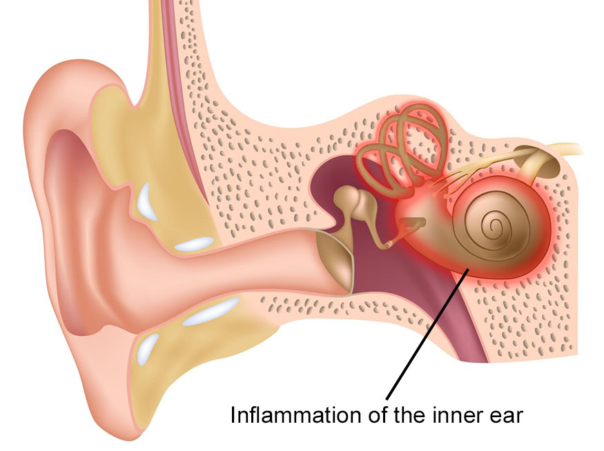 What does a viral ear infection feel like
